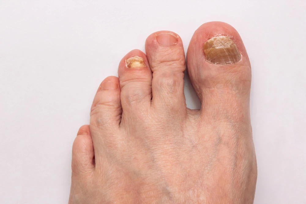 Tratamento para fungos nas unhas dos pés