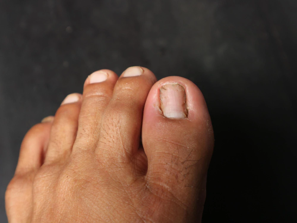 Tratamento de unha encravada